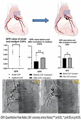 The functional impact on donor vessel following transcatheter closure of coronary artery fistulas—a retrospective study using QFR analysis